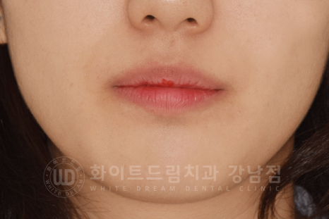 강남 덧니 비발치교정 / 임플란트와 치아교정 동시 진행 case 리뷰. 관련 이미지 5