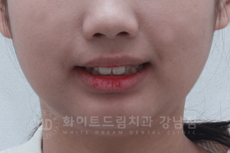 신논현역 라미네이트 / 과개교합 치아교정 + 왜소치 라미네이트 진행 case 관련 이미지 15