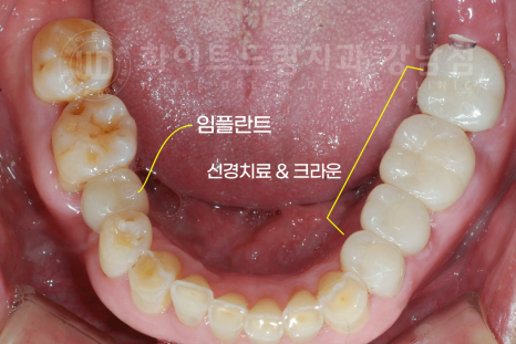 강남역 임플란트치과 / "어금니가 없고 이갈이가 심해요" 강남역 화이트드림치과 관련 이미지 14