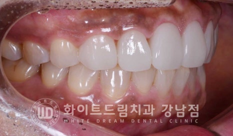 깨진앞니 라미네이트 / 깨지고 누렇게 변한 앞니는? 원데이 라미네이트 치료 사례 관련 이미지 16