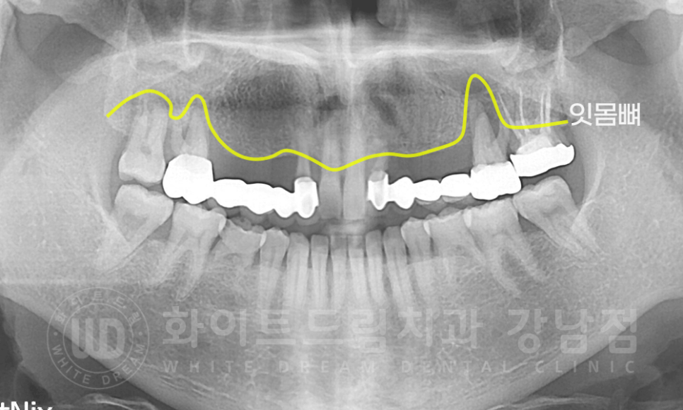 강남역 치과브릿지 "브릿지가 흔들려요" 흔들리는 브릿지 치료는? 관련 이미지 5