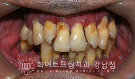 강남역 전악임플란트치과 / 치주 질환이 치아와 임플란트에 끼치는 영향! 관련 이미지 18