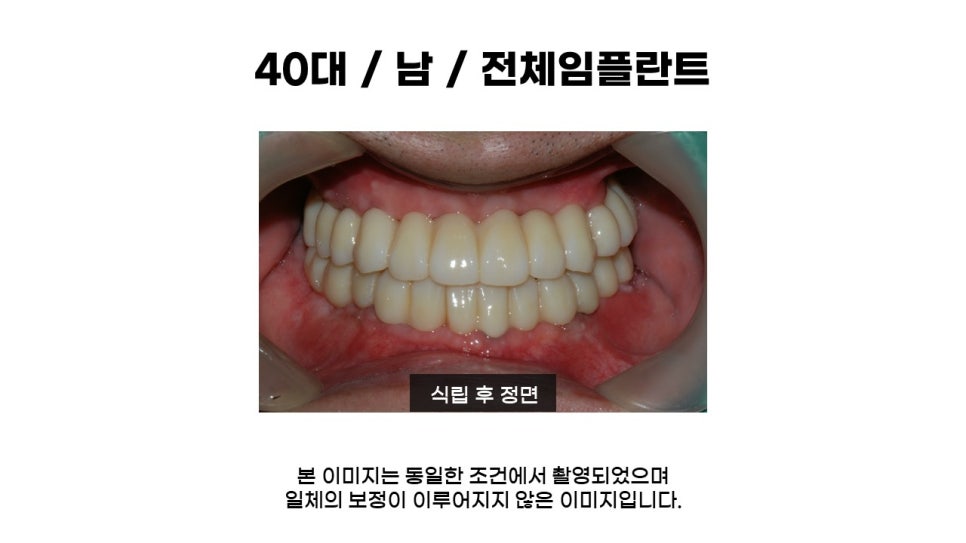 40대임플란트식립후기 및 어금니임플란트 가격, 종류 알아보기 위해 관련 이미지 9