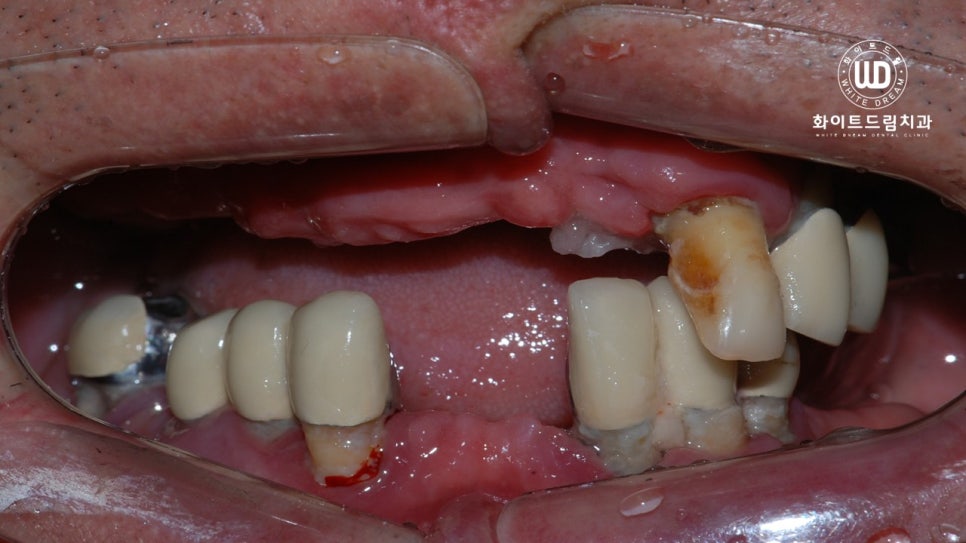 무너진 잇몸뼈와 치아 상실을 대체하는 전악임플란트 치료 사례 관련 이미지 6