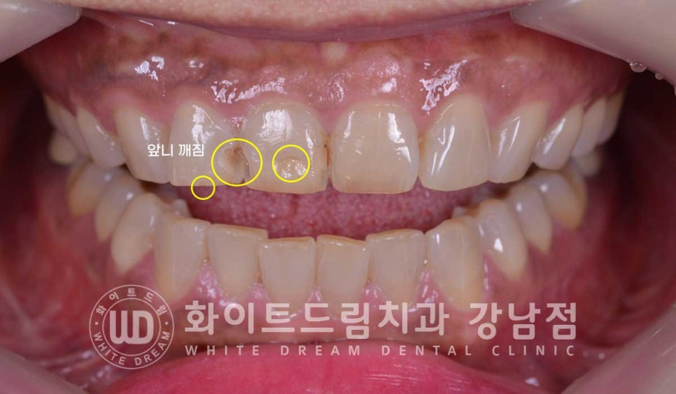 깨진앞니 라미네이트 / 깨지고 누렇게 변한 앞니는? 원데이 라미네이트 치료 사례 관련 이미지 4