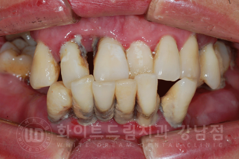 강남역 전체임플란트 치과 "치아가 심하게 흔들려요." 심한 치주염 임플란트 치료 관련 이미지 15
