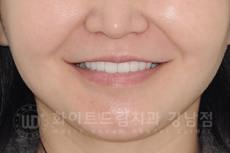 강남역 원데이 라미네이트 "유튜브 촬영하는데 치아가 신경 쓰여요" #강남화이트드림치과 관련 이미지 5