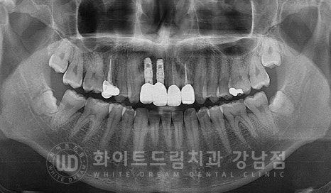 앞니 임플란트 사례 "예전에 심은 임플란트를 뺐어요. 재수술 가능할까요?" 관련 이미지 15