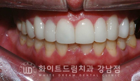 앞니 레진변색 "너무 지저분해 보여요." 라미네이트로 깔끔하게 교체한 치료 사례 관련 이미지 11