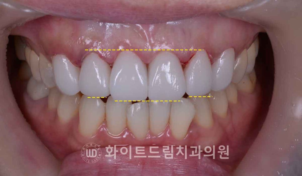 뱅뱅사거리치과 "라미네이트가 마음에 들지 않아요. 하얗고 균일한 치아를 갖고 싶어요." 강남역 화이트드림치과 관련 이미지 11