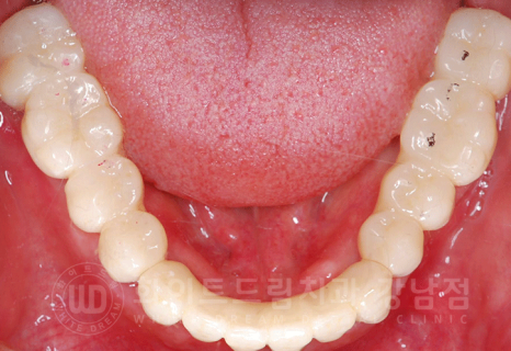 강남역 전체임플란트 치과 "치아가 심하게 흔들려요." 심한 치주염 임플란트 치료 관련 이미지 18