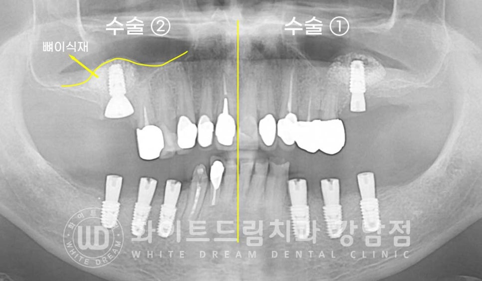임플란트 개수를 줄일 수 있는 방법? (+치아를 발치한지 오래되었나요?) 관련 이미지 10
