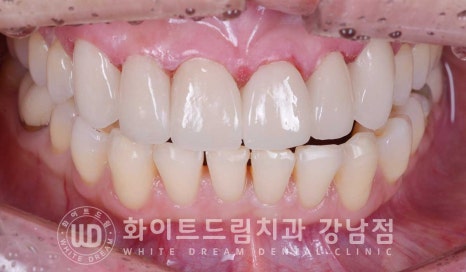 앞니 뻐드러짐 라미네이트 "뻐드러지고 벌어진 앞니" 당일 라미네이트 치료 case 관련 이미지 12