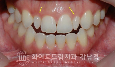 앞니 레진변색 "너무 지저분해 보여요." 라미네이트로 깔끔하게 교체한 치료 사례 관련 이미지 7