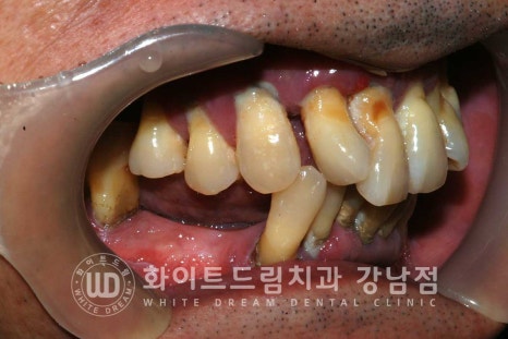강남역 전악임플란트치과 / 치주 질환이 치아와 임플란트에 끼치는 영향! 관련 이미지 5