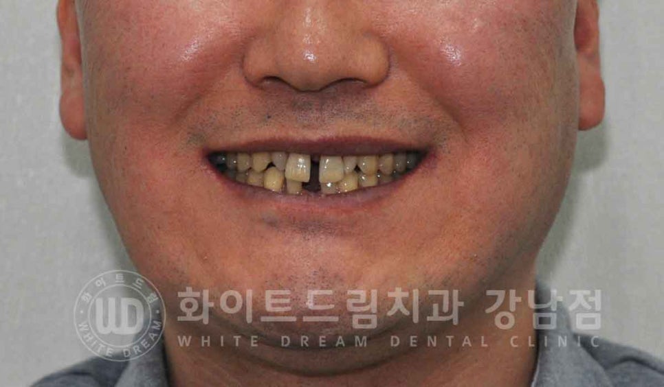 강남역 결손치 "앞니 두 개가 없고, 벌어졌어요" 결손치 치료 방법 관련 이미지 6
