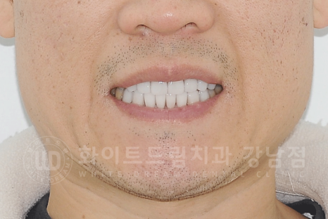 강남역 인근 치과 / 테트라사이클린(tetracycline) 치아 변색 / 라미네이트로 개선! 관련 이미지 20