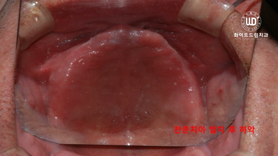 전체 치조골 이식을 동반한 고혈압 환자 임플란트 사례 관련 이미지 4