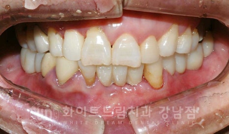 잇몸뼈가 없다는 게 무슨 말일까? "틀니를 오래 사용해서 잇몸뼈가 없대요" 임플란트 잘하는 강남치과 관련 이미지 14