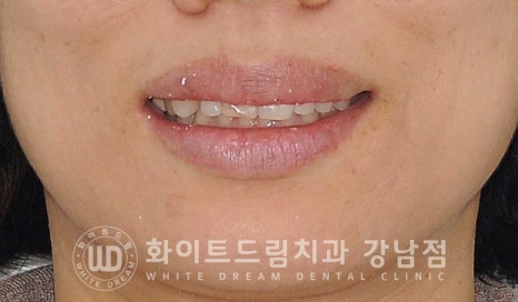 앞니 원데이라미네이트 / 떨어진 앞니 레진 & 벌어진 앞니, 라미네이트로 당일 개선 ★ 관련 이미지 8