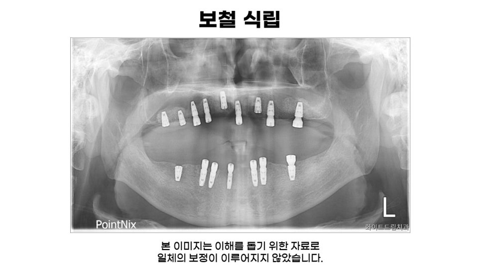 어금니임플란트 수복 및 당뇨환자임플란트 가격, 종류, 통증 관련 이미지 9