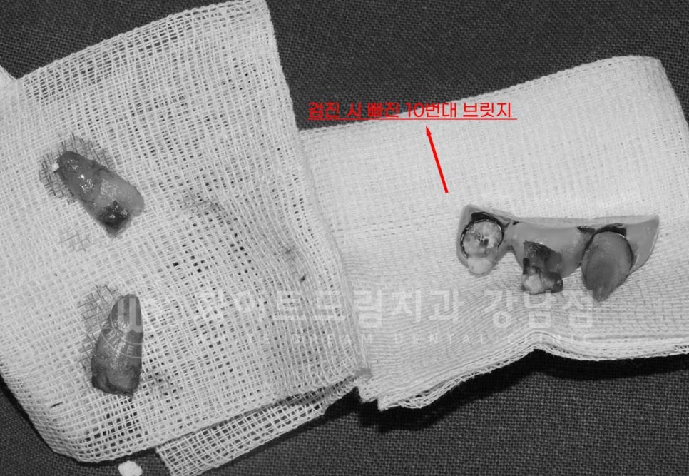 임플란트 1차 수술, 2차 수술이란 무엇일까? (+ 상악 전체 임플란트 치료 기간) 관련 이미지 6