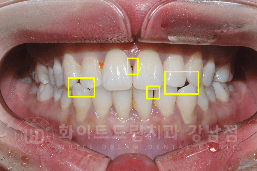 강남역 원데이 라미네이트 "유튜브 촬영하는데 치아가 신경 쓰여요" #강남화이트드림치과 관련 이미지 6