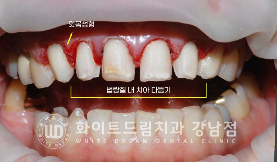 앞니 원데이라미네이트, 뻐드러지고 벌어진 앞니! 당일 치료 ok 관련 이미지 14