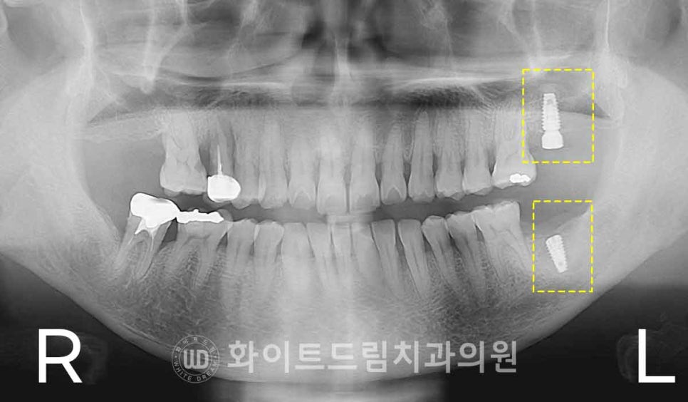 강남역치과 임플란트 "발치 후 바로 임플란트가 가능한 경우 vs 기다려야 하는 경우" 관련 이미지 7