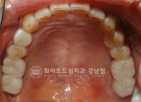 신경치료 후 크라운을 해야 하는 이유 / 크라운을 안 해 부러진 치아 임플란트 치료 case 관련 이미지 18