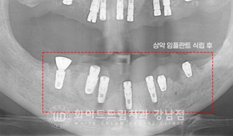 치주염 전체임플란트, 염증으로 인한 상악동 천공 & 신경관 가까이 녹은 잇몸뼈. 임플란트 식립 가능할까? 관련 이미지 11