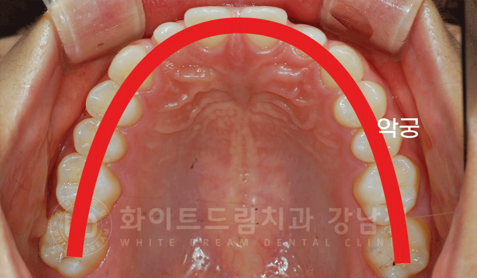 강남 벌어진앞니 교정 / "심하게 벌어진 치아, 어떻게?" 부분교정 + 라미네이트로 개선! 관련 이미지 3