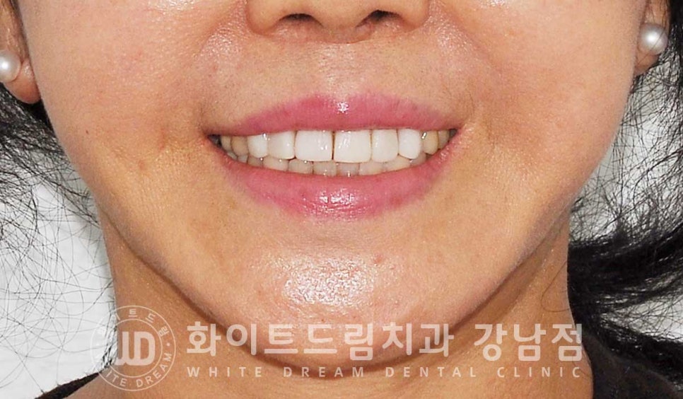 앞니라미네이트 교체 "5년 전에 한 라미네이트가 뻗쳐 보여요" 예쁘게 치료할 수 있나요? 관련 이미지 2