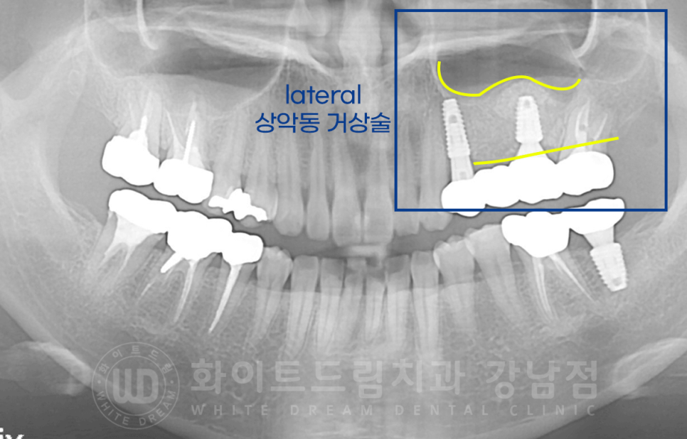 서초동 어금니 임플란트 / 강남역 화이트드림치과 : 상악동 거상술 (crestal approch) 관련 이미지 12
