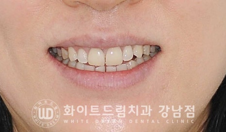 벌어진 앞니 라미네이트 / 50대 시니어 라미네이트 치료 사례 관련 이미지 9