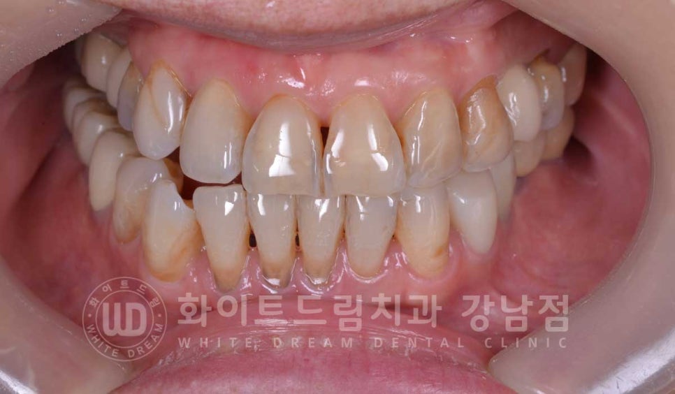 노화된 치아 라미네이트 / 치아미백을 해도 하얘지지 않는 마모된 치아는 어떻게 할까? 관련 이미지 4