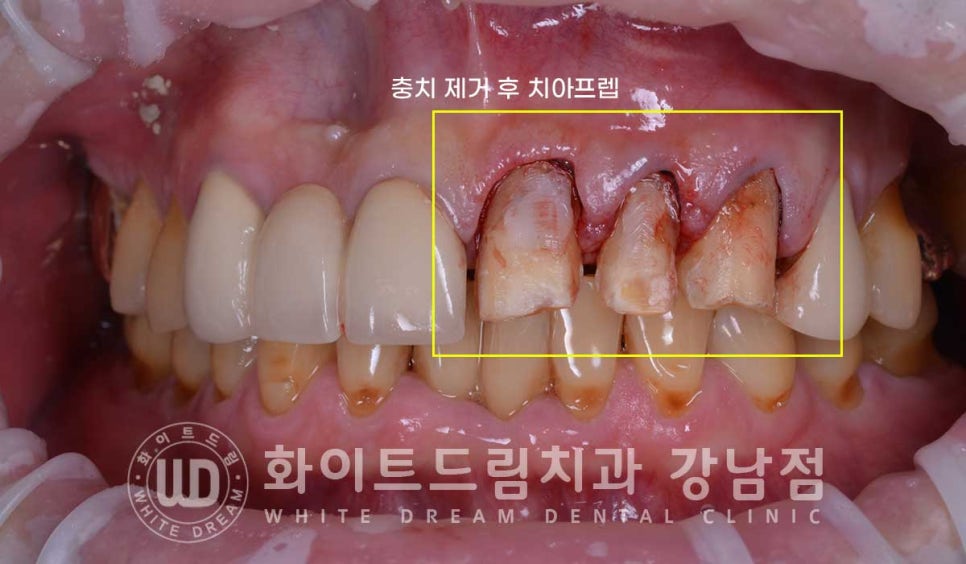 앞니 충치 라미네이트 치료 / "옆 크라운과 치아 색상을 맞추고 싶어요" 관련 이미지 8