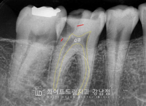 신경치료 후 크라운을 해야 하는 이유 / 크라운을 안 해 부러진 치아 임플란트 치료 case 관련 이미지 10
