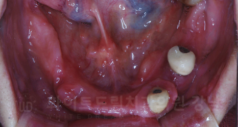 강남역 임플란트 치과 "틀니가 안 맞아서 불편해요" 틀니 → 전체 임플란트로! 관련 이미지 7