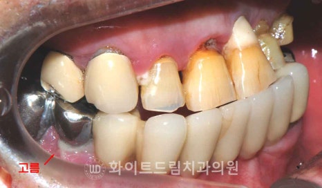 서울전체임플란트잘하는치과, 왜 치주염이 심해지면 반대교합까지 생길까요? (치주염 전체 임플란트 CASE) 관련 이미지 6