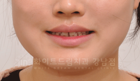 강남 벌어진앞니 교정 / "심하게 벌어진 치아, 어떻게?" 부분교정 + 라미네이트로 개선! 관련 이미지 5