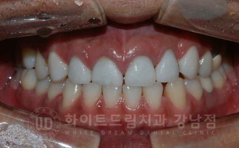 역삼역 앞니 치료  "예전에 한 크라운, 라미네이트 바꾸고 싶어요" 라미네이트 & 크라운 재치료 관련 이미지 9