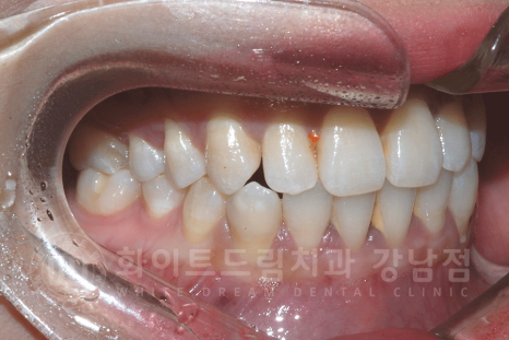 강남역 원데이 라미네이트 "유튜브 촬영하는데 치아가 신경 쓰여요" #강남화이트드림치과 관련 이미지 7