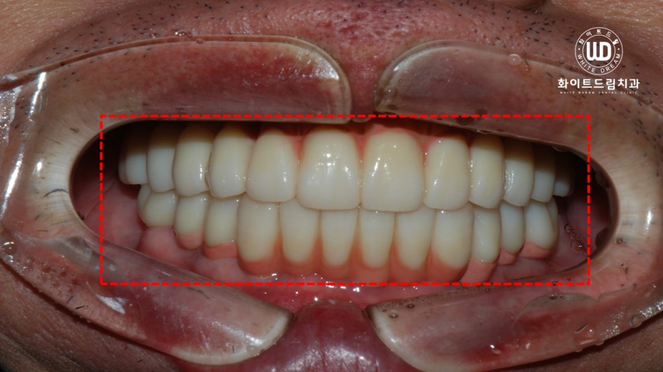 무너진 잇몸뼈와 치아 상실을 대체하는 전악임플란트 치료 사례 관련 이미지 7