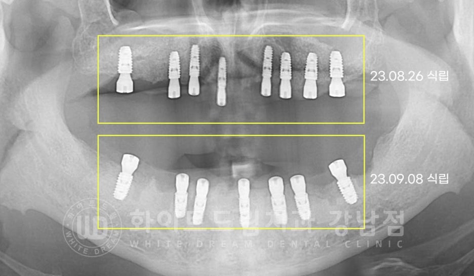 Gangnam Station Dental Clinic Specializing in Implant Revision Surgery—Revision Surgery and Full-Mouth Implant Treatment at the Same Time! image 7
