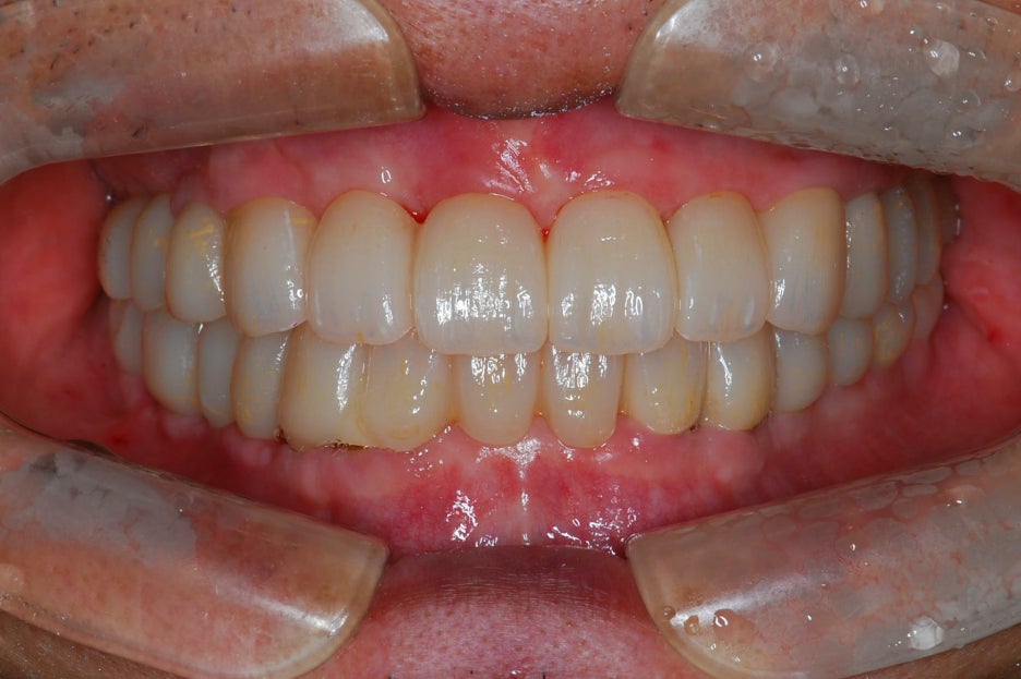 임플란트 하기 전 알아보아야 할 것. 관련 이미지 18