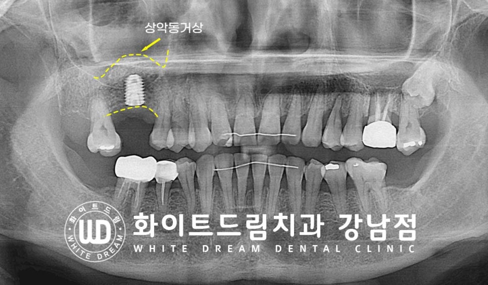상악 어금니 임플란트 치료 시 동반되는 "상악동 거상술" 이란? 관련 이미지 8
