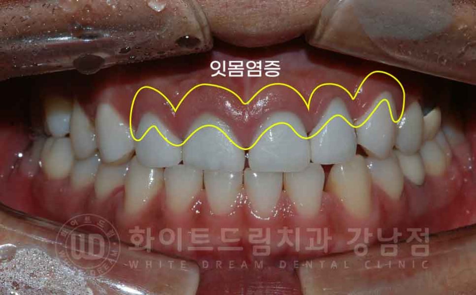 역삼역 앞니 치료  "예전에 한 크라운, 라미네이트 바꾸고 싶어요" 라미네이트 & 크라운 재치료 관련 이미지 5