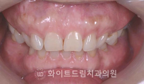 강남옹니라미네이트 "치아가 안으로 들어가서 할머니처럼 보여요" 경미 & 중증도 옹니 라미네이트 치료 관련 이미지 17