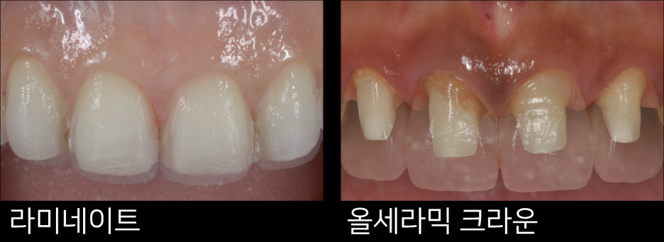 라미네이트 치료에 대해 알아보면? 관련 이미지 4